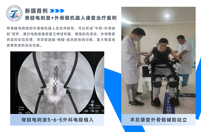 新疆醫(yī)科大學第七附屬醫(yī)院分享首例脊髓電刺激+外骨骼治療！